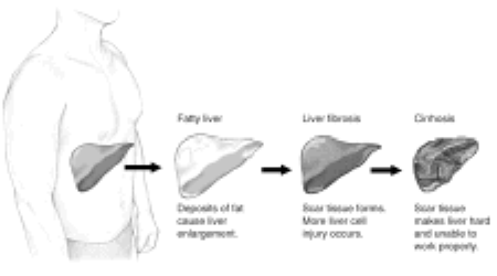 NAFLD